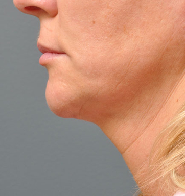 NON-SURGICAL FACE LIFT - Patient 1 - After NON-SURGICAL FACE LIFT - Patient 1 - After